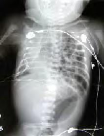 This x-ray shows intestines (air inside them is black) in the chest and the heart is squeezed to the right side