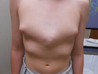 🥇 Dallas TX Pectus Carinatum/Excavatum/Female Pigeon Chest